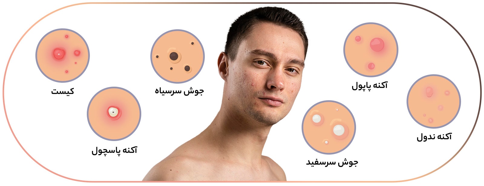انواع جوش صورت