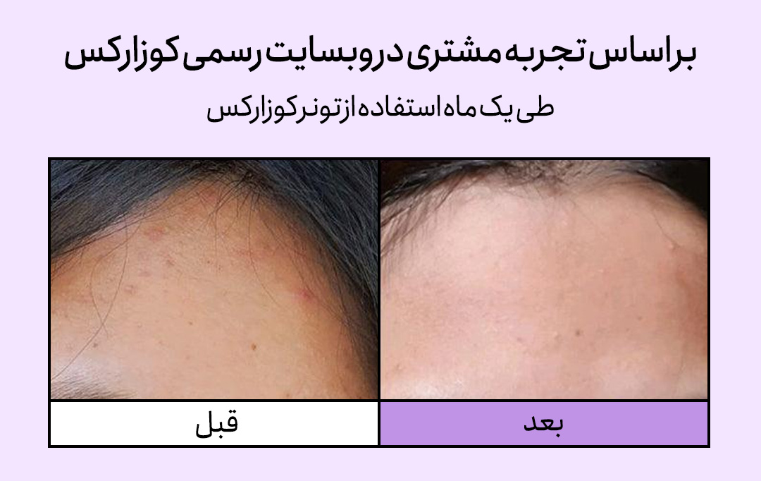 خرید تونر لایه بردار و روشن کننده AHA BHA کوزارکس اصل برای انواع پوست