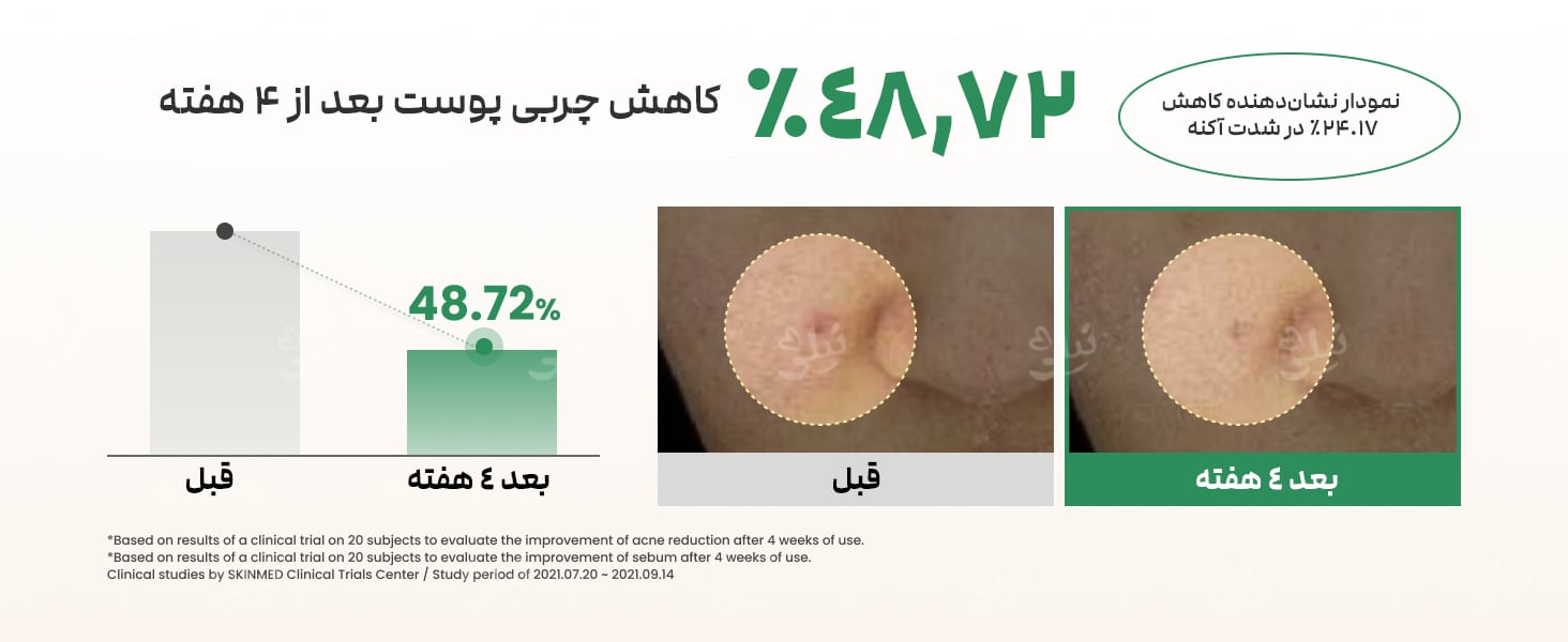 قبل و بعد سرم ضد جوش، لک و آکنه اکسیس وای
