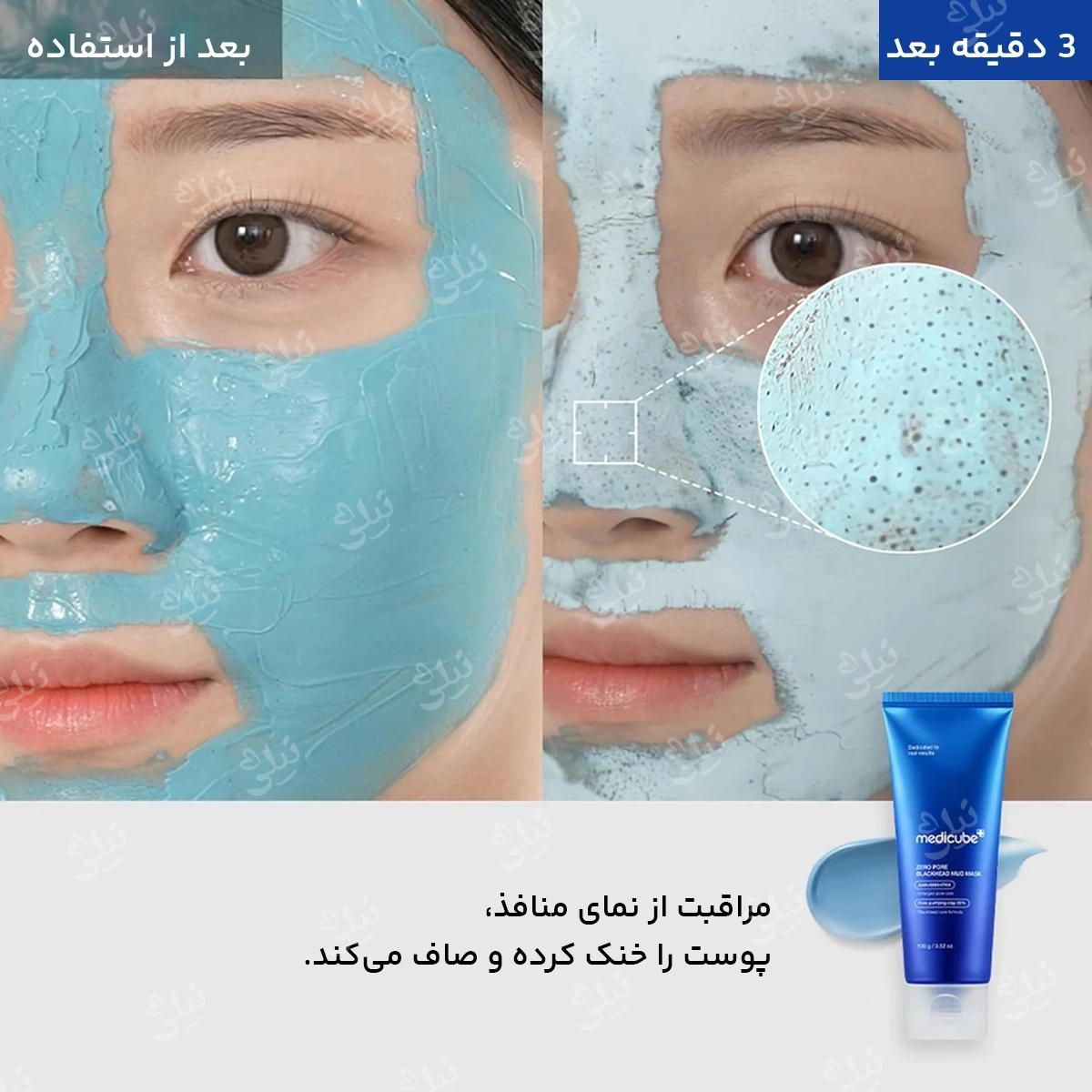 قبل و بعد استفاده از ماسک ضد جوش مدی کیوب