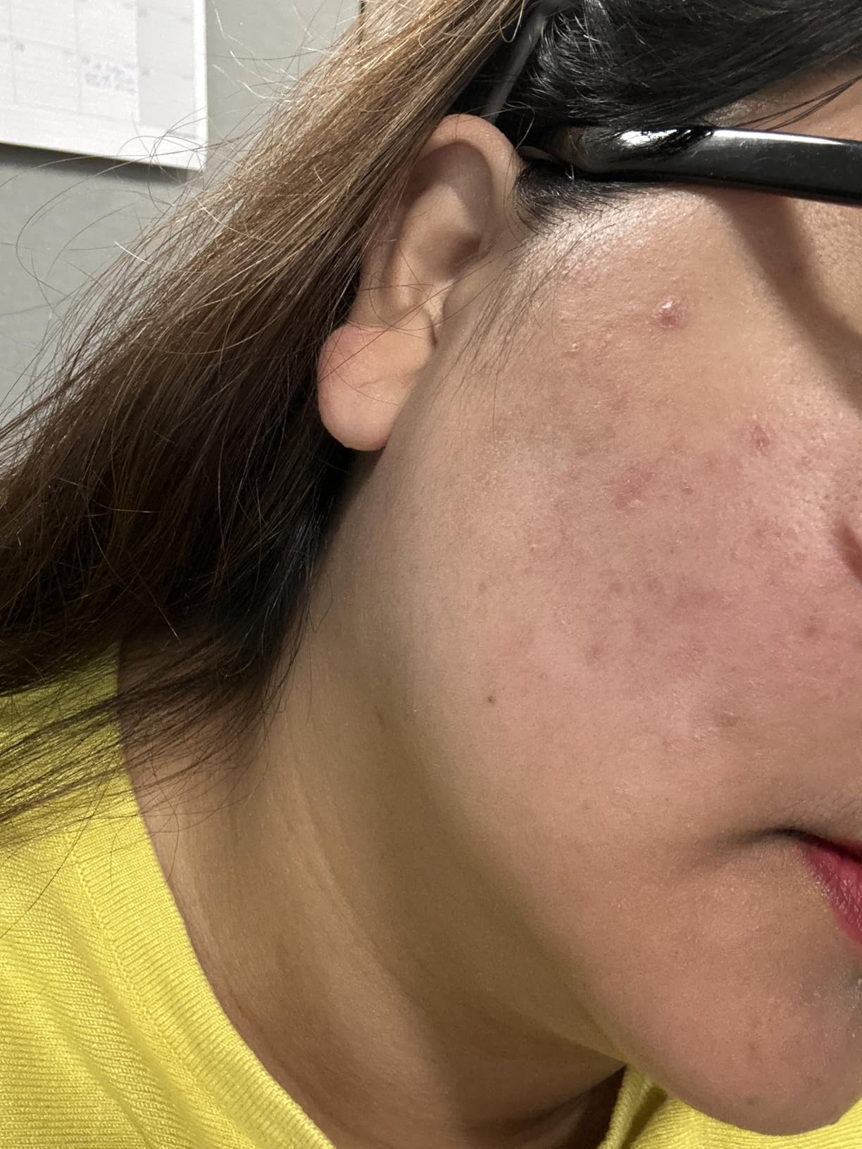 نمای نزدیک پوست صورت پس از استفاده از فوم شوینده کوجیک اسید و زردچوبه مدیکوب؛ مناسب پاکسازی و کمک به شفاف‌تر دیده‌شدن پوست